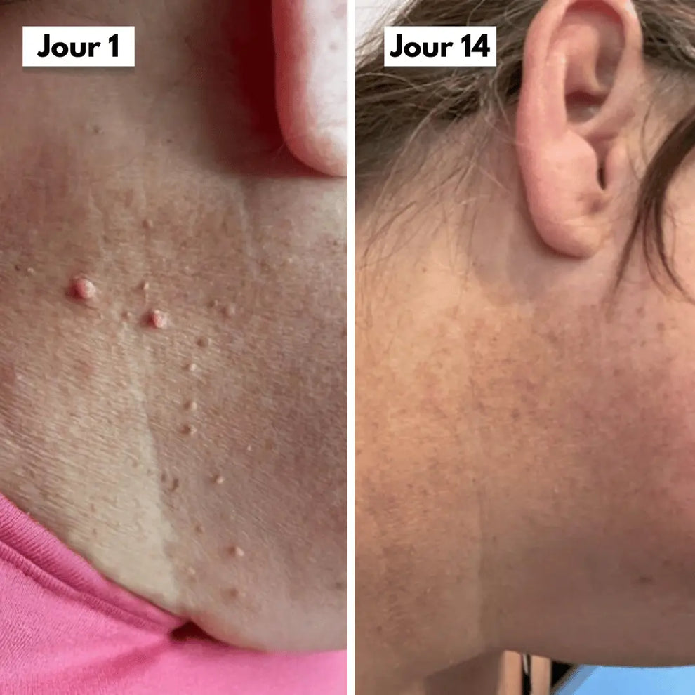 Éliminez ces excroissances en quelques jours, sans douleur