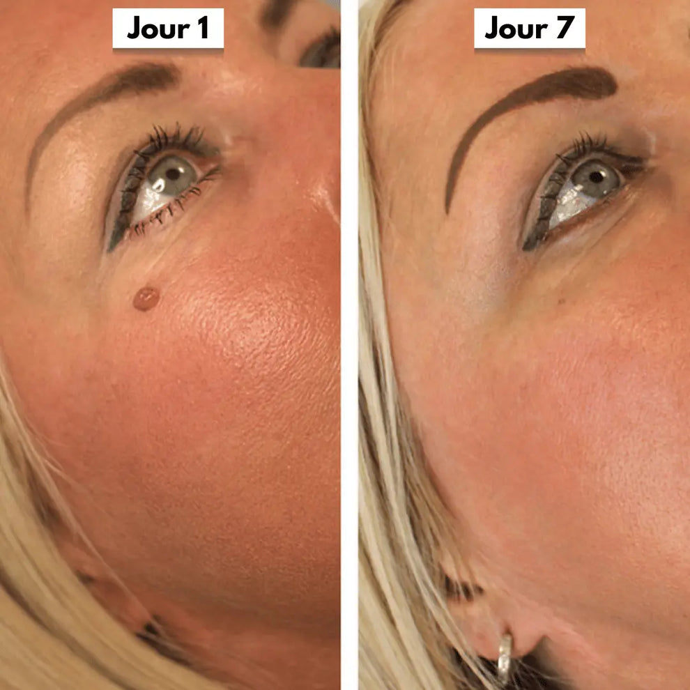 Éliminez ces excroissances en quelques jours, sans douleur