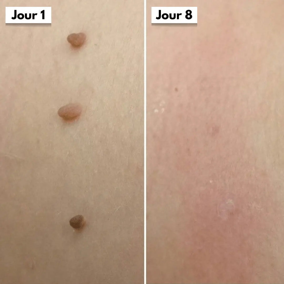 Éliminez ces excroissances en quelques jours, sans douleur