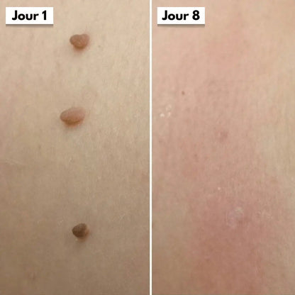 Éliminez ces excroissances en quelques jours, sans douleur