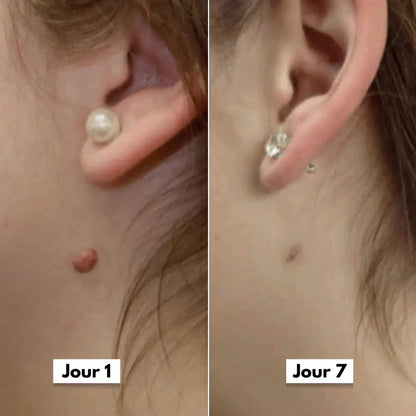 Éliminez ces excroissances en quelques jours, sans douleur
