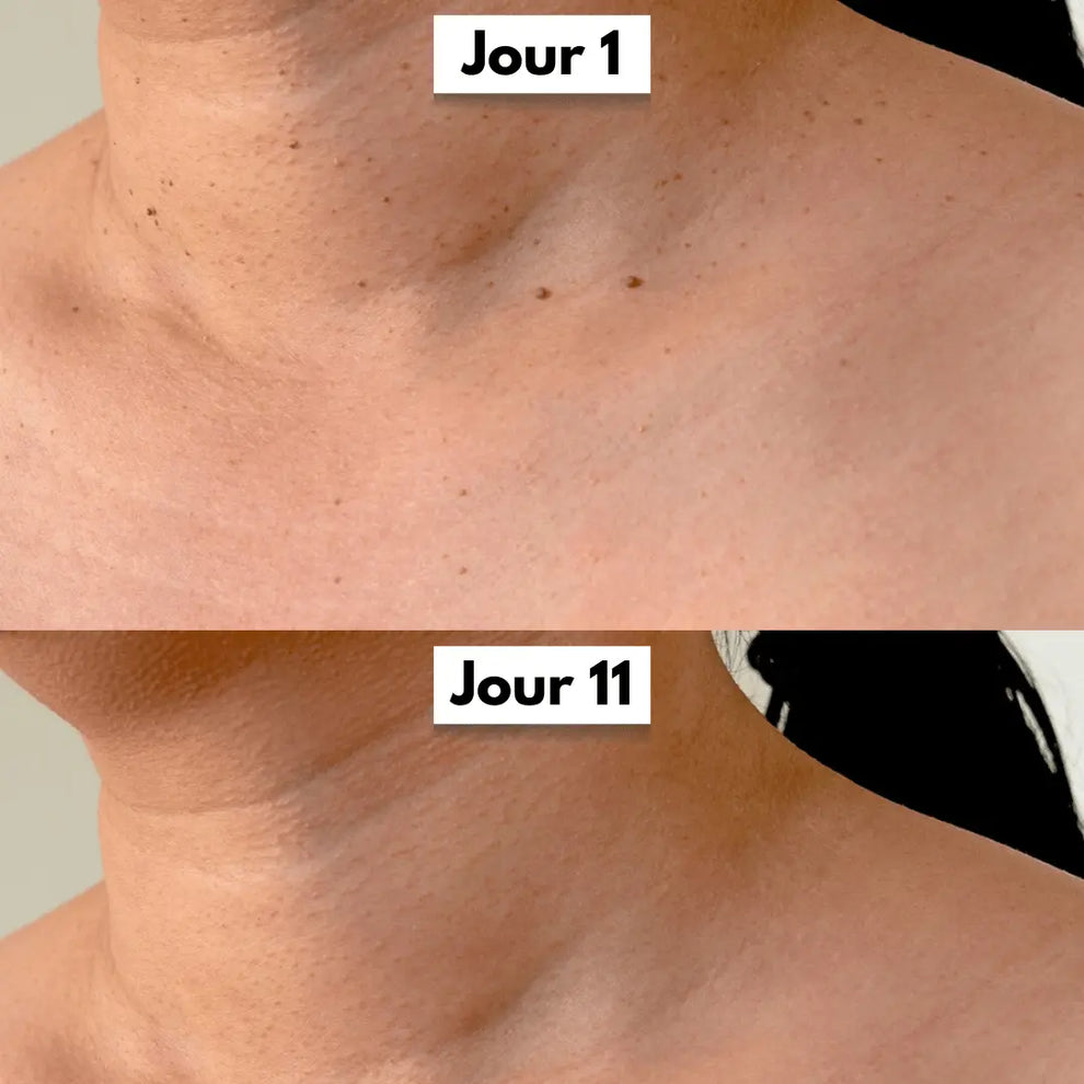 Éliminez ces excroissances en quelques jours, sans douleur